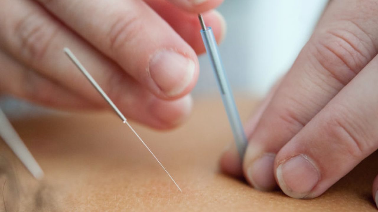 acupuntura- ariculoterapia